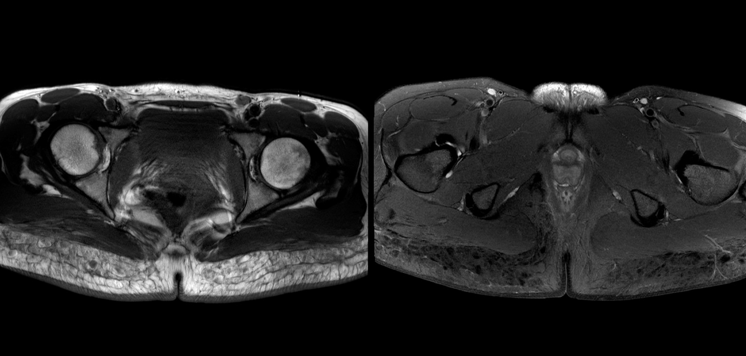 Figure 2 for case Silicon granuloma gluteal augmentation